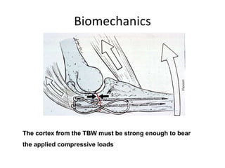 Biomechanics
The cortex from the TBW must be strong enough to bear
the applied compressive loads
 