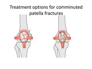 Treatment options for comminuted
patella fractures
 