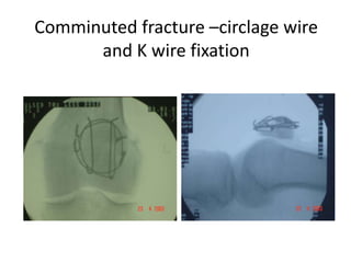 Comminuted fracture –circlage wire
and K wire fixation
 