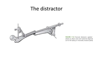 The distractor
 