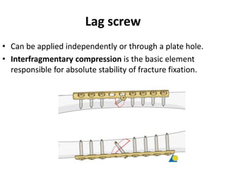 Lag screw
• Can be applied independently or through a plate hole.
• Interfragmentary compression is the basic element
responsible for absolute stability of fracture fixation.
 