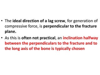 • The ideal direction of a lag screw, for generation of
compressive force, is perpendicular to the fracture
plane.
• As this is often not practical, an inclination halfway
between the perpendiculars to the fracture and to
the long axis of the bone is typically chosen
 