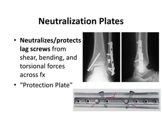 Neutralization Plates
• Neutralizes/protects
lag screws from
shear, bending, and
torsional forces
across fx
• “Protection Plate"
 