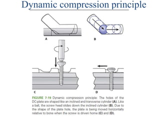 Dynamic compression principle
•
 