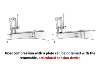 Axial compression with a plate can be obtained with the
removable, articulated tension device
 