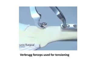 Verbrugg forceps used for tensioning
 