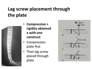Lag screw placement through
the plate
• Compression +
rigidity obtained
a with one
construct
• Compression
plate first
• Then lag screw
placed through
plate
 