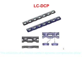 The structure of a limited-contact dynamic compression plate.
LC-DCP
 