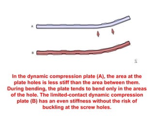 In the dynamic compression plate (A), the area at the
plate holes is less stiff than the area between them.
During bending, the plate tends to bend only in the areas
of the hole. The limited-contact dynamic compression
plate (B) has an even stiffness without the risk of
buckling at the screw holes.
 