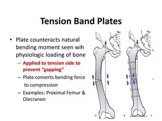 Tension Band Plates
• Plate counteracts natural
bending moment seen wih
physiologic loading of bone
– Applied to tension side to
prevent “gapping”
– Plate converts bending force
to compression
– Examples: Proximal Femur &
Olecranon
 