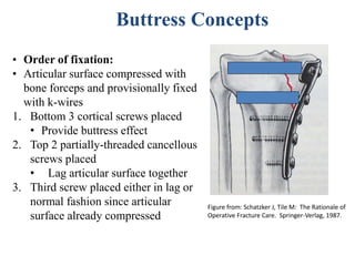 • Order of fixation:
• Articular surface compressed with
bone forceps and provisionally fixed
with k-wires
1. Bottom 3 cortical screws placed
• Provide buttress effect
2. Top 2 partially-threaded cancellous
screws placed
• Lag articular surface together
3. Third screw placed either in lag or
normal fashion since articular
surface already compressed
Buttress Concepts
Figure from: Schatzker J, Tile M: The Rationale of
Operative Fracture Care. Springer-Verlag, 1987.
 