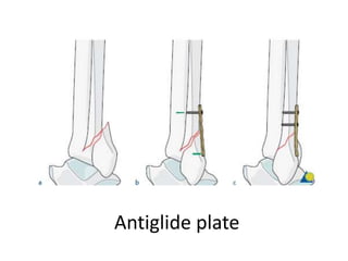 Antiglide plate
 