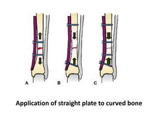 Application of straight plate to curved bone
 