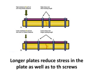 Longer plates reduce stress in the
plate as well as to th screws
 