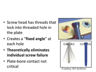 • Screw head has threads that
lock into threaded hole in
the plate
• Creates a “fixed angle” at
each hole
• Theoretically eliminates
individual screw failure
• Plate-bone contact not
critical Courtesy AO Archives
 