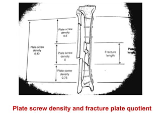 Plate screw density and fracture plate quotient
 