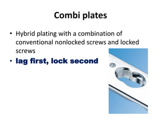 Combi plates
• Hybrid plating with a combination of
conventional nonlocked screws and locked
screws
• lag first, lock second
 