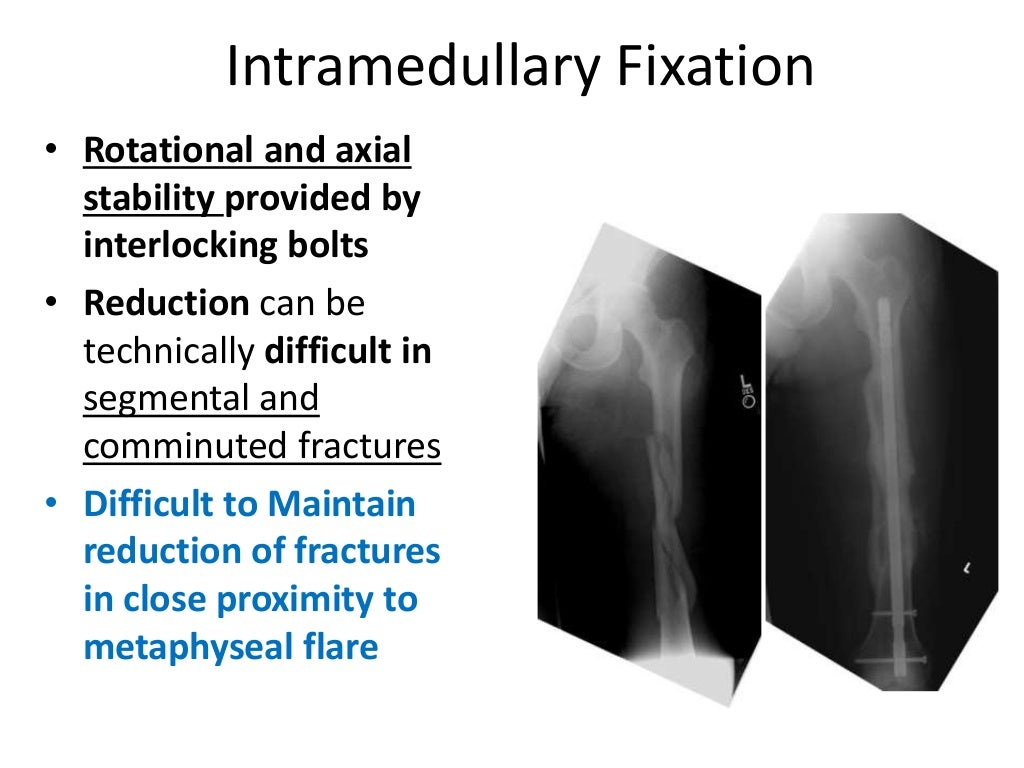 Principles of internal fixation