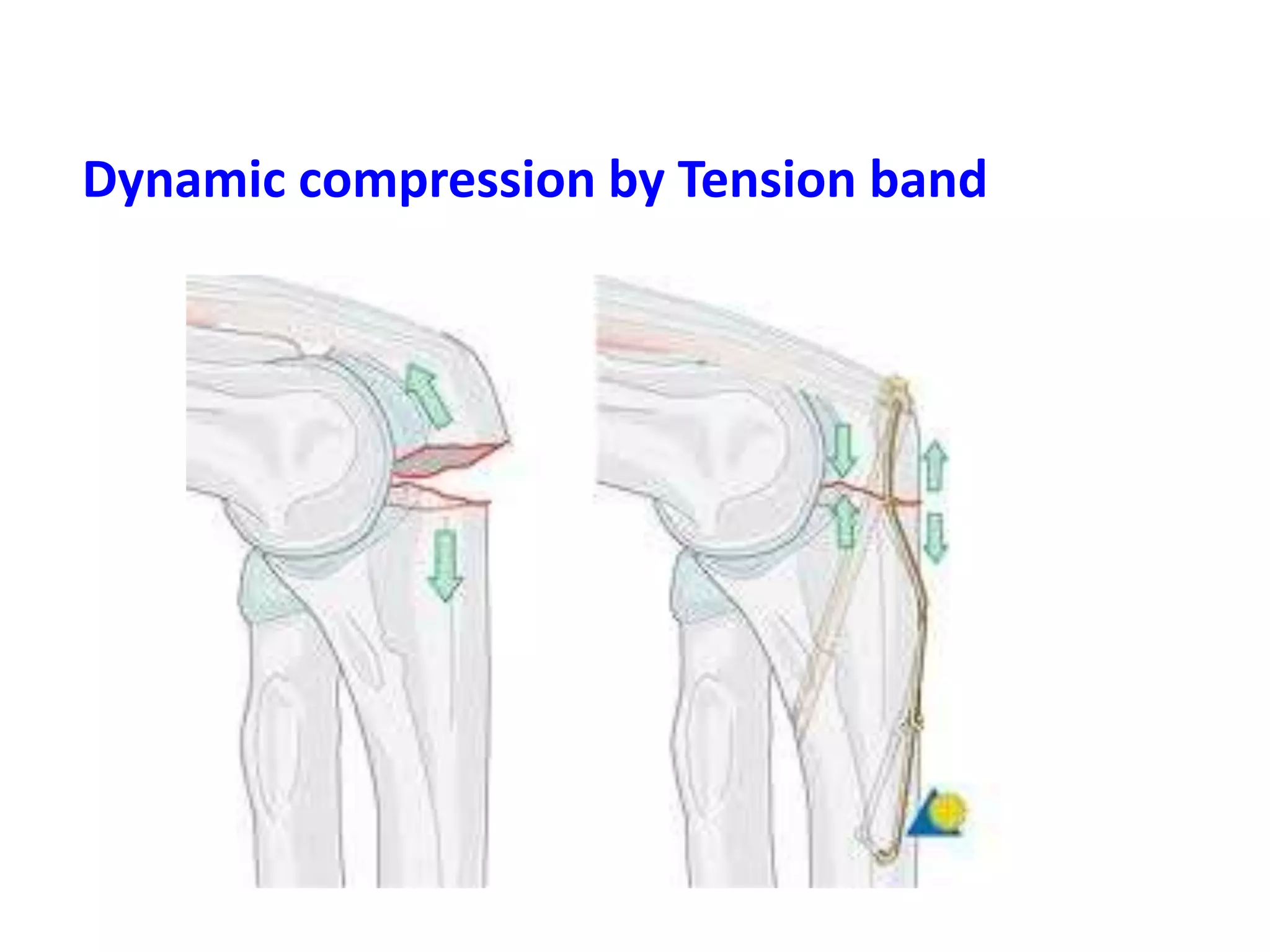 Dynamic compression by Tension band
 