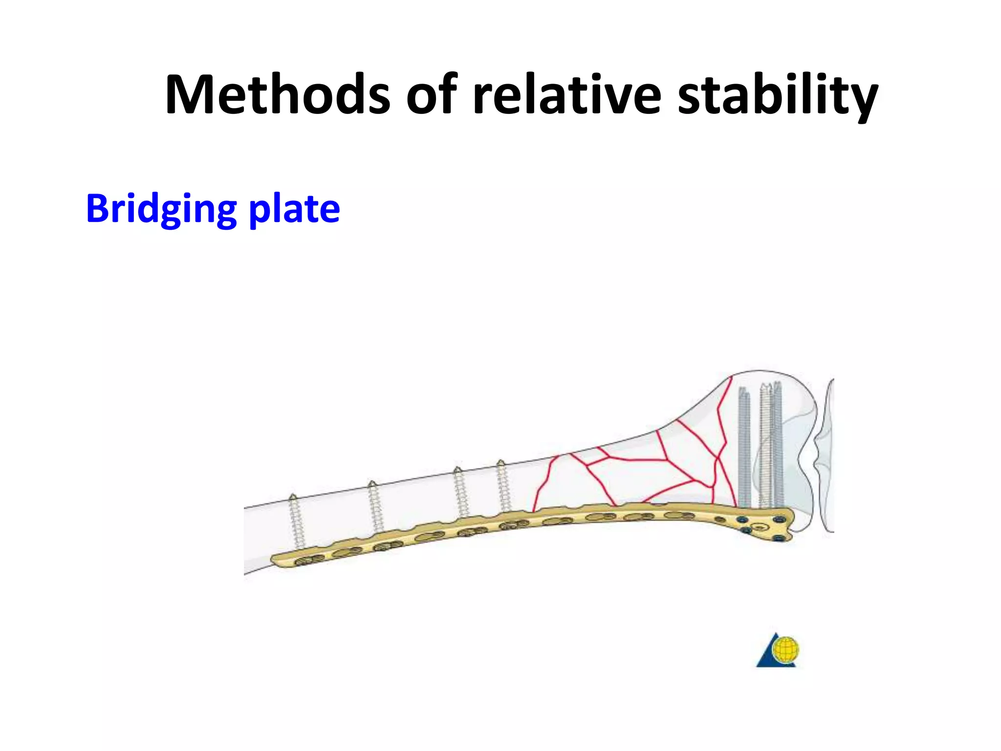 Methods of relative stability
Bridging plate
 