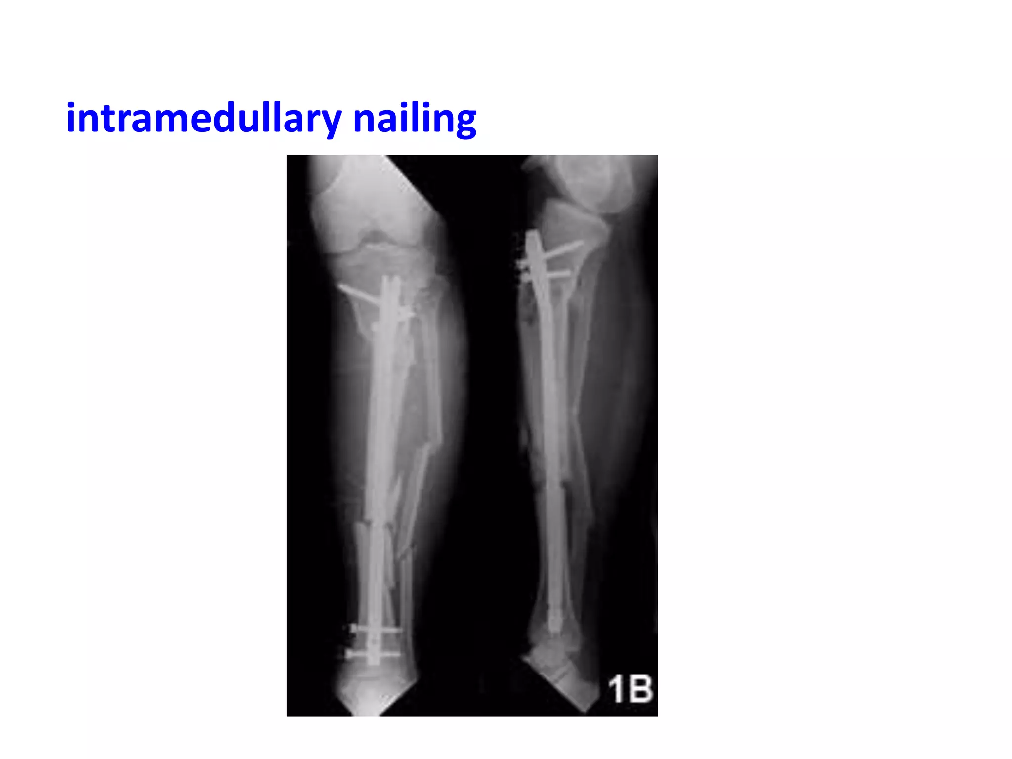 intramedullary nailing
 