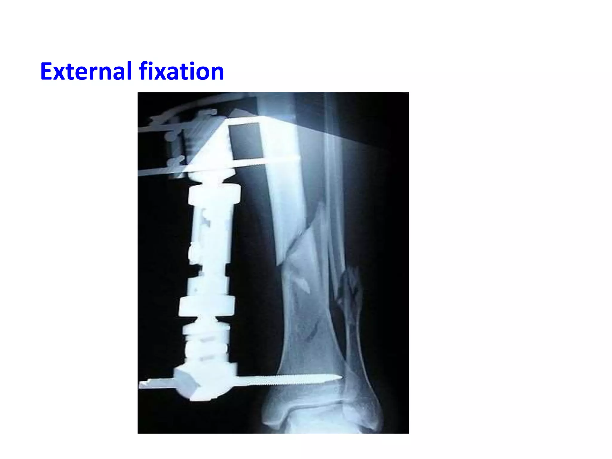 External fixation
 