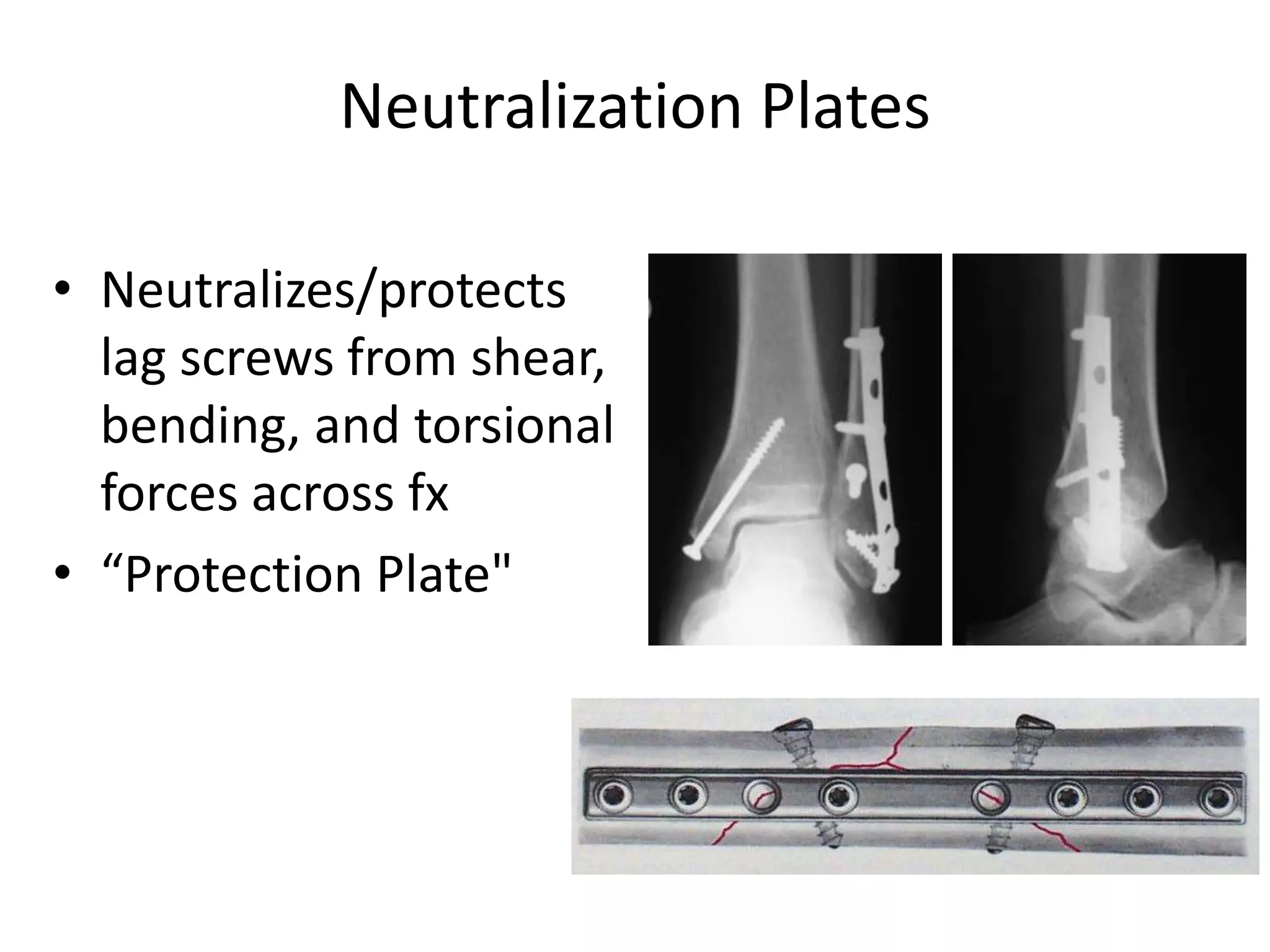 Neutralization Plates
• Neutralizes/protects
lag screws from shear,
bending, and torsional
forces across fx
• “Protection Plate"
 