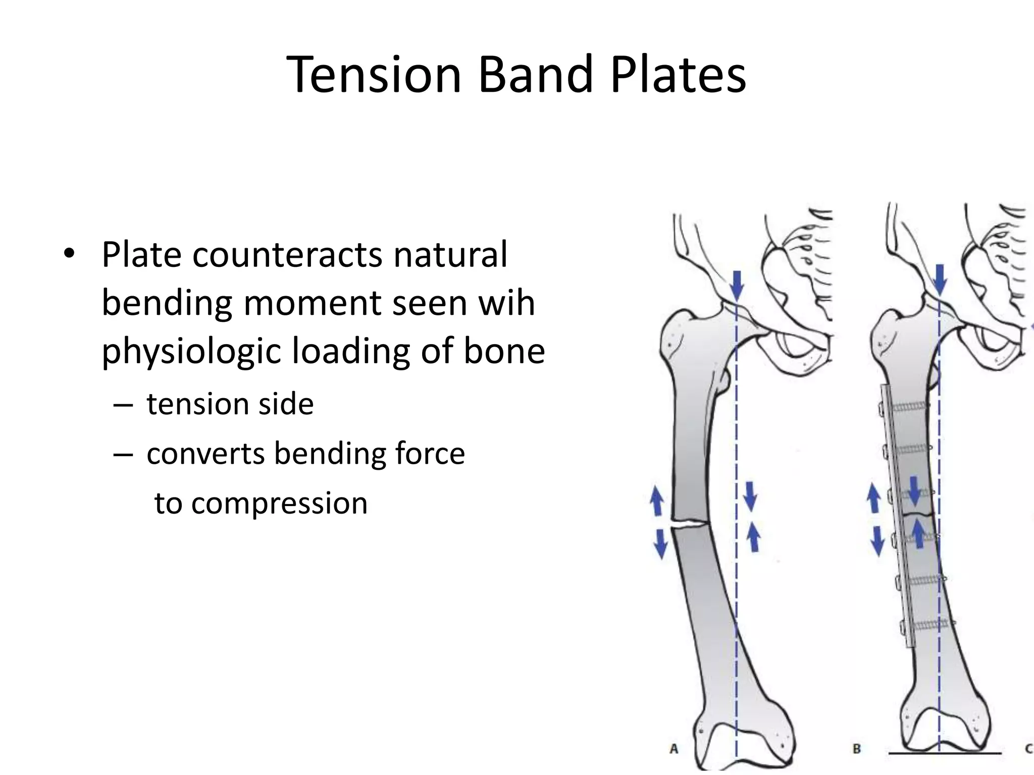 Tension Band Plates
• Plate counteracts natural
bending moment seen wih
physiologic loading of bone
– tension side
– converts bending force
to compression
 