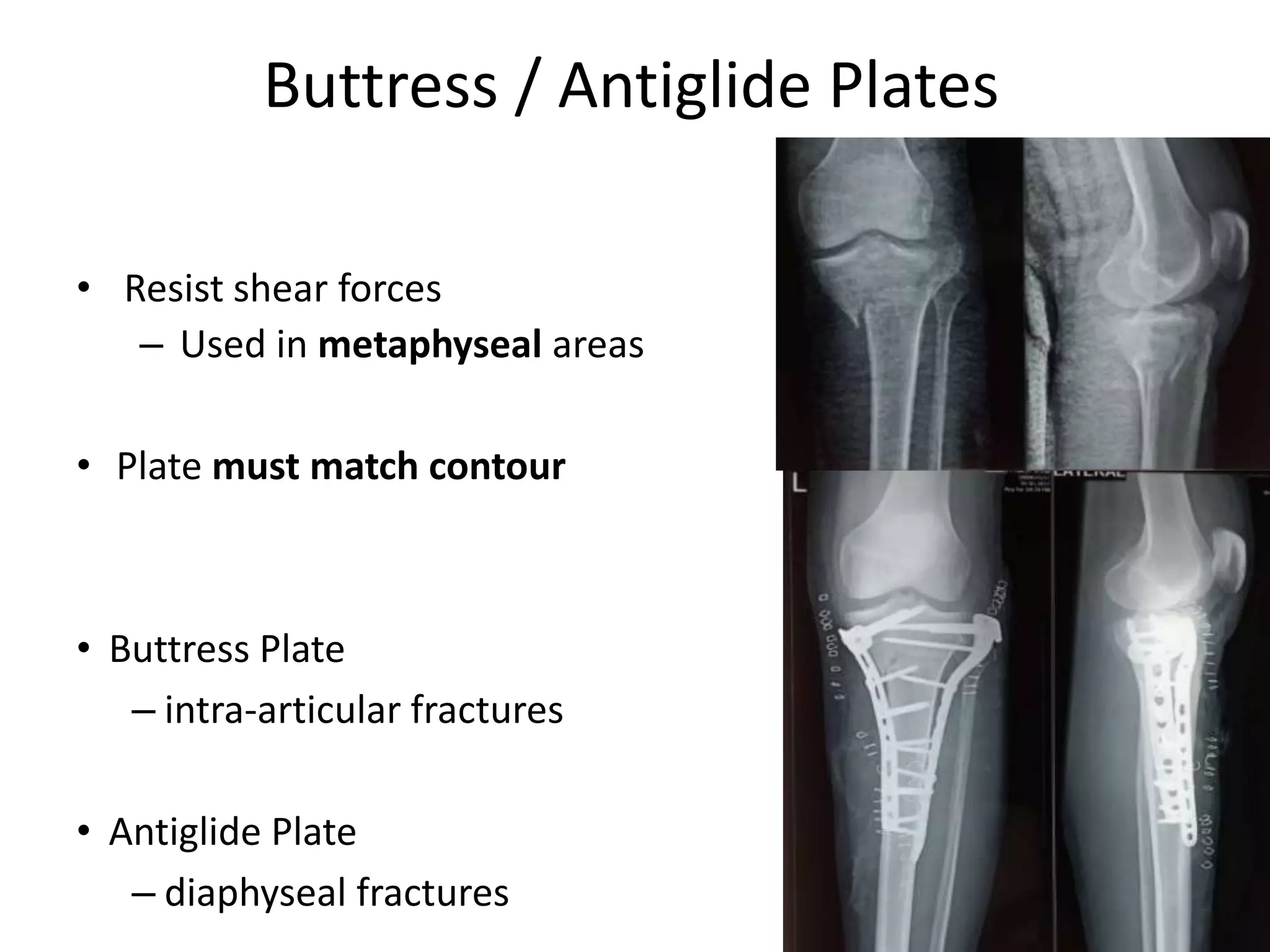 Buttress / Antiglide Plates
• Resist shear forces
– Used in metaphyseal areas
• Plate must match contour
• Buttress Plate
– intra-articular fractures
• Antiglide Plate
– diaphyseal fractures
 