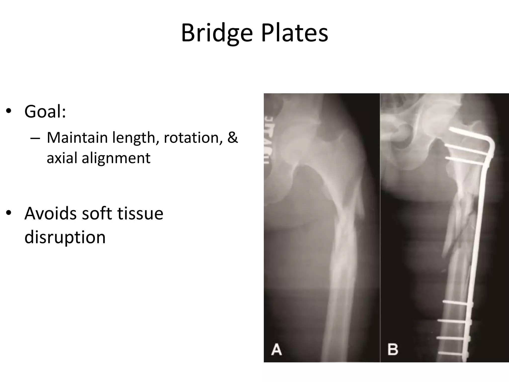 Bridge Plates
• Goal:
– Maintain length, rotation, &
axial alignment
• Avoids soft tissue
disruption
 