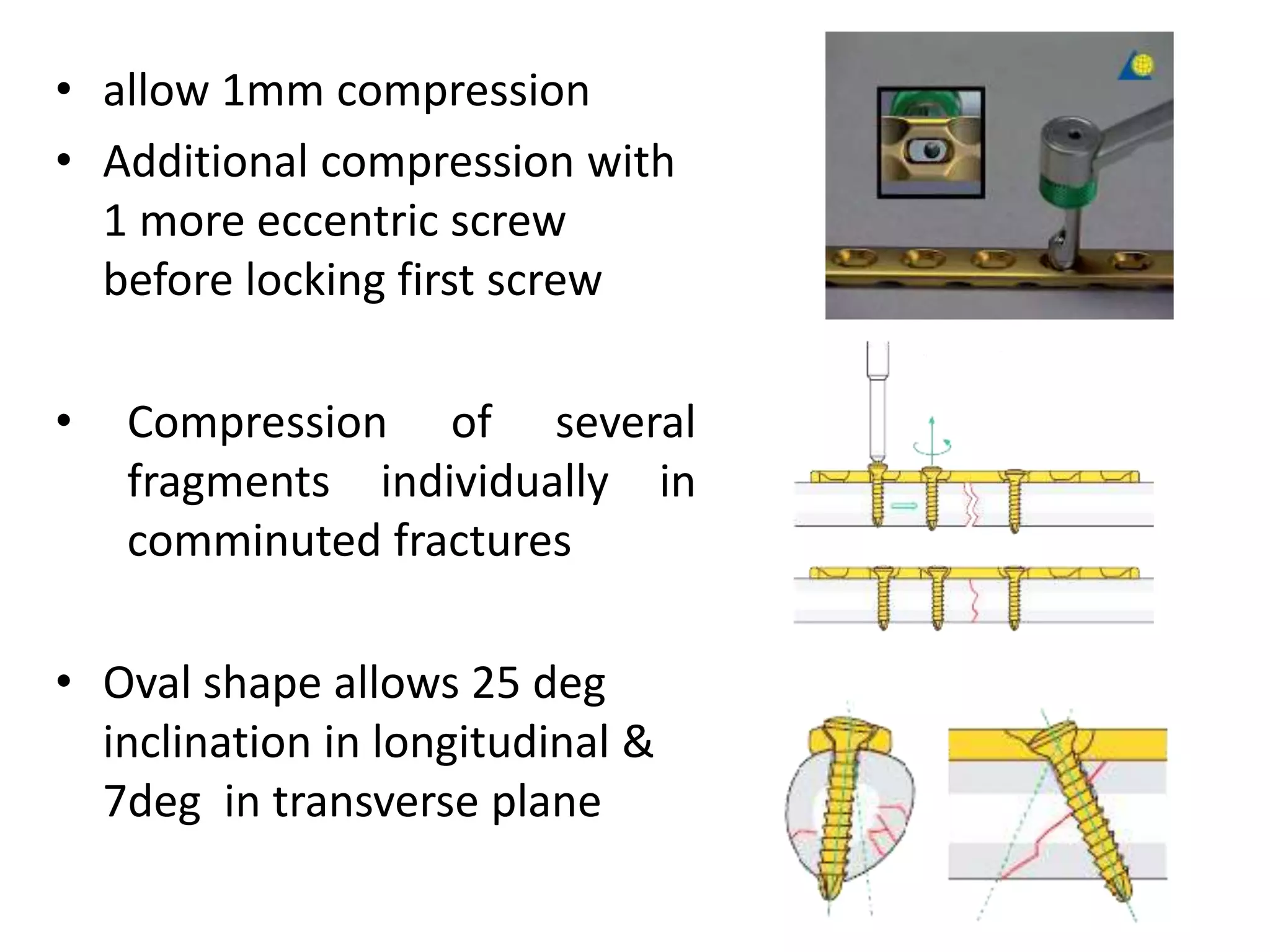 • allow 1mm compression
• Additional compression with
1 more eccentric screw
before locking first screw
• Compression of several
fragments individually in
comminuted fractures
• Oval shape allows 25 deg
inclination in longitudinal &
7deg in transverse plane
 