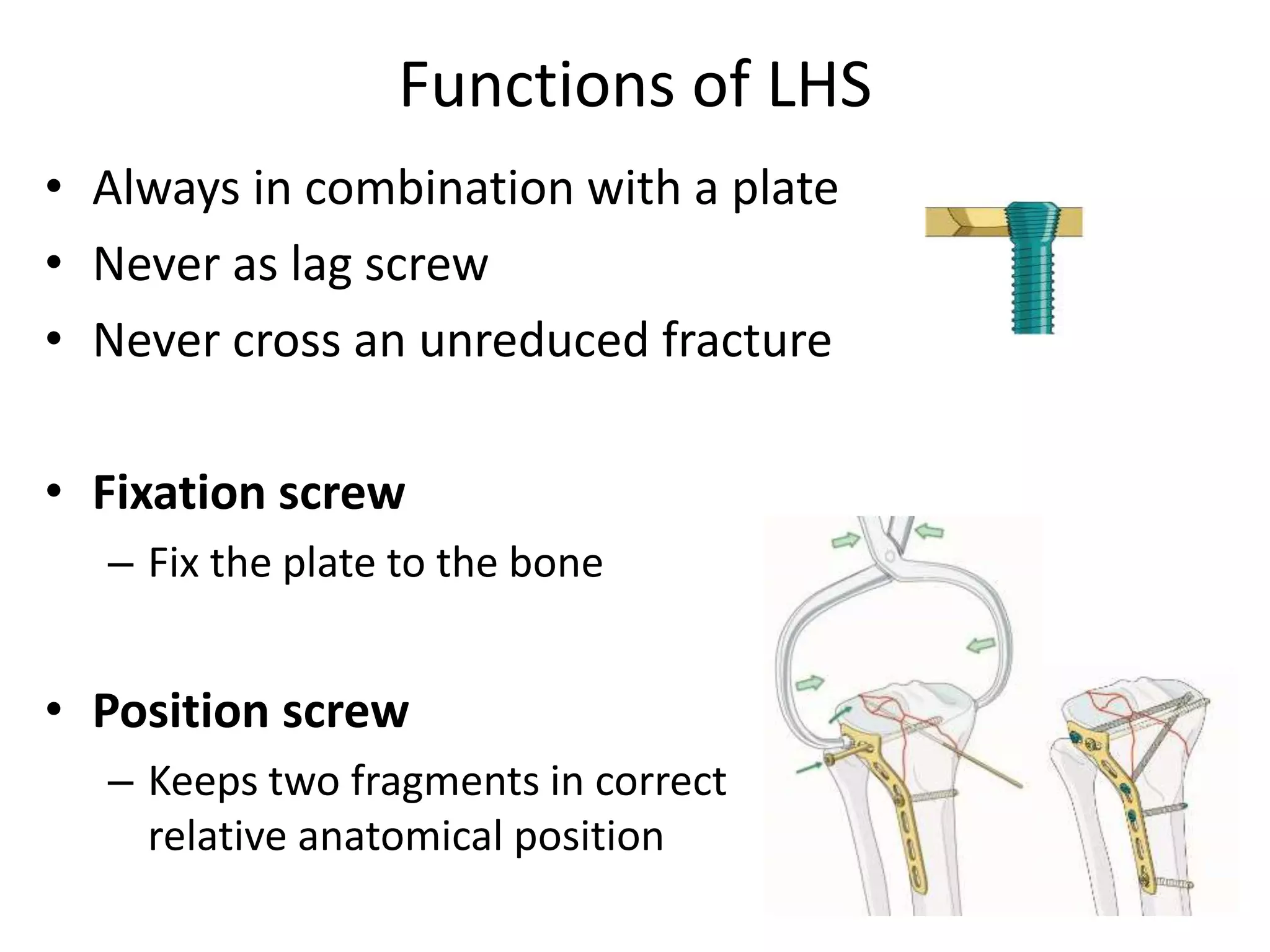 Functions of LHS
• Always in combination with a plate
• Never as lag screw
• Never cross an unreduced fracture
• Fixation screw
– Fix the plate to the bone
• Position screw
– Keeps two fragments in correct
relative anatomical position
 