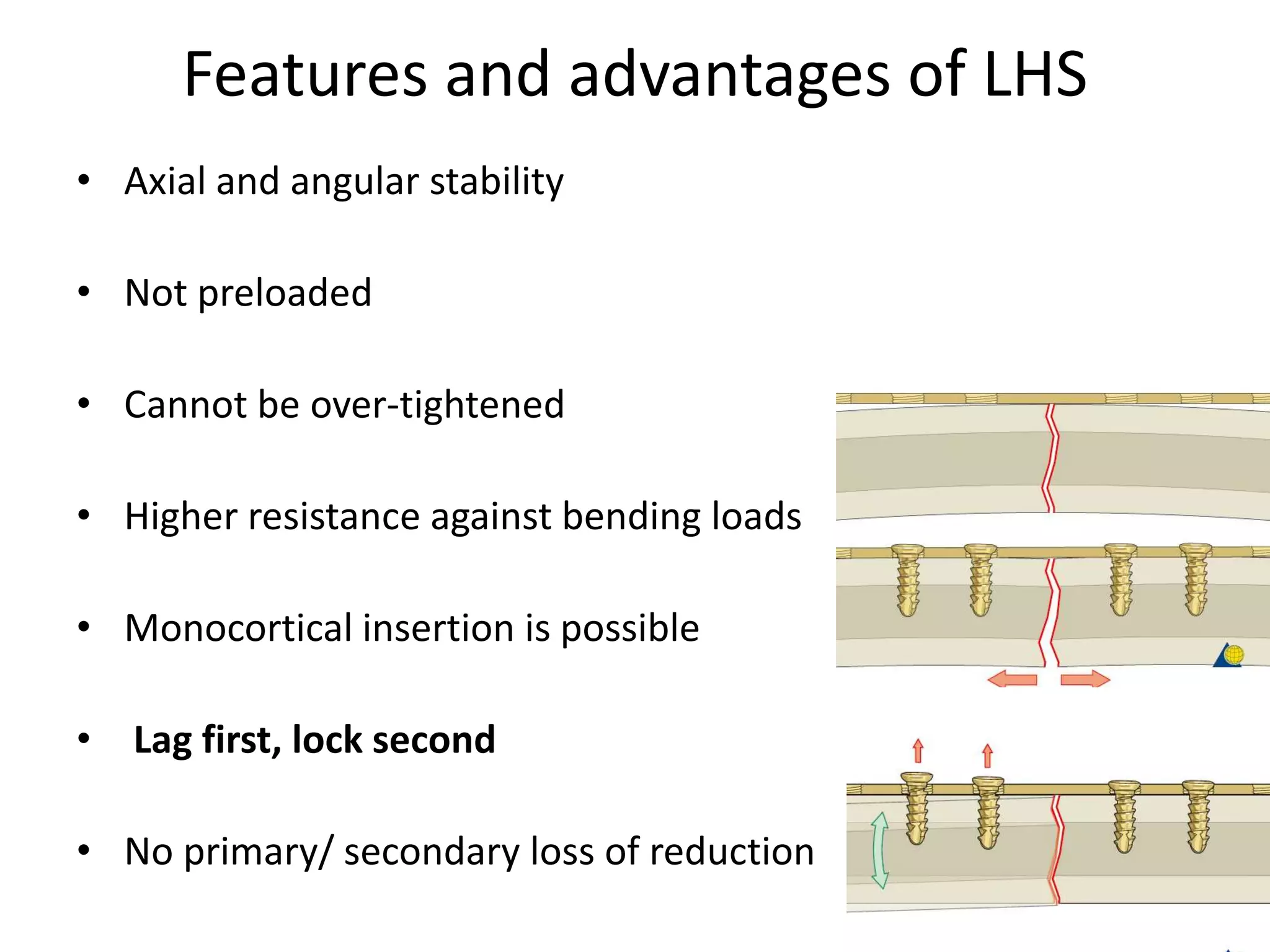 Features and advantages of LHS
• Axial and angular stability
• Not preloaded
• Cannot be over-tightened
• Higher resistance against bending loads
• Monocortical insertion is possible
• Lag first, lock second
• No primary/ secondary loss of reduction
 