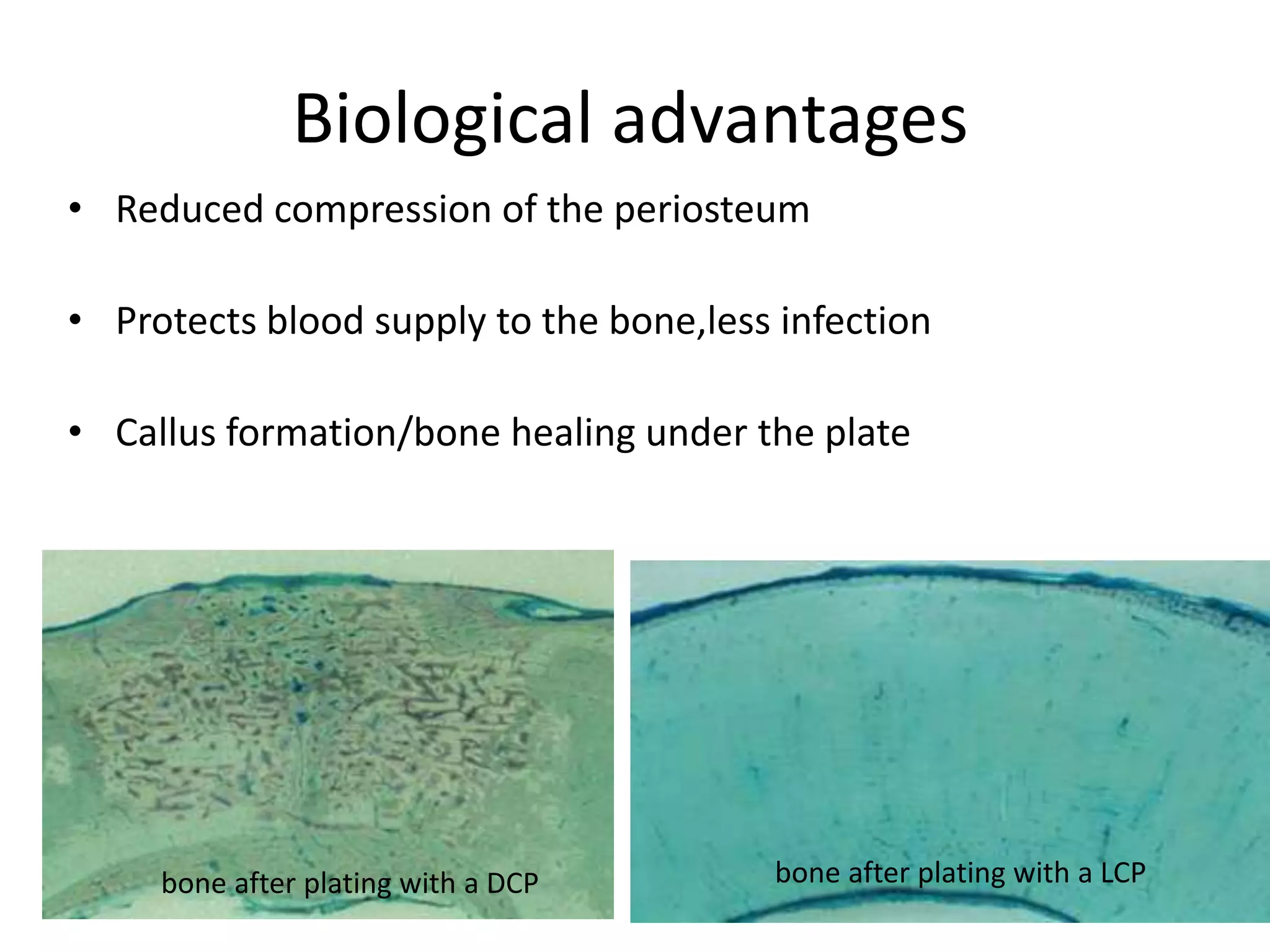 Biological advantages
• Reduced compression of the periosteum
• Protects blood supply to the bone,less infection
• Callus formation/bone healing under the plate
bone after plating with a DCP bone after plating with a LCP
 