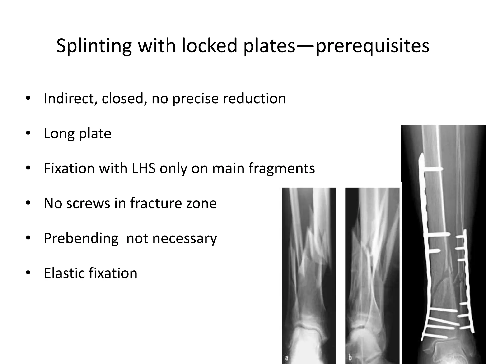 Splinting with locked plates—prerequisites
• Indirect, closed, no precise reduction
• Long plate
• Fixation with LHS only on main fragments
• No screws in fracture zone
• Prebending not necessary
• Elastic fixation
 