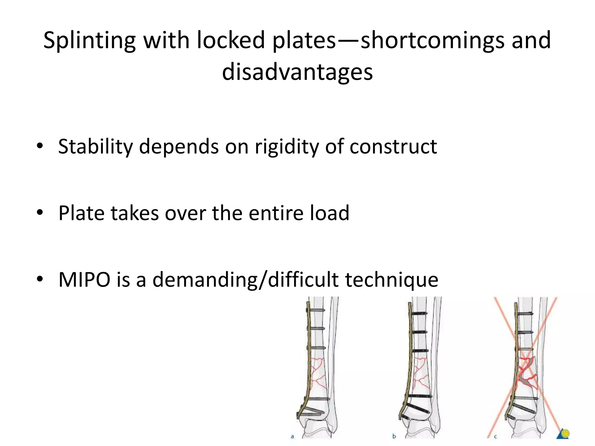 Splinting with locked plates—shortcomings and
disadvantages
• Stability depends on rigidity of construct
• Plate takes over the entire load
• MIPO is a demanding/difficult technique
 