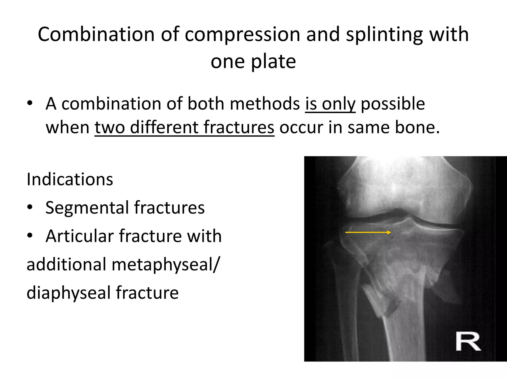 Combination of compression and splinting with
one plate
• A combination of both methods is only possible
when two different fractures occur in same bone.
Indications
• Segmental fractures
• Articular fracture with
additional metaphyseal/
diaphyseal fracture
 
