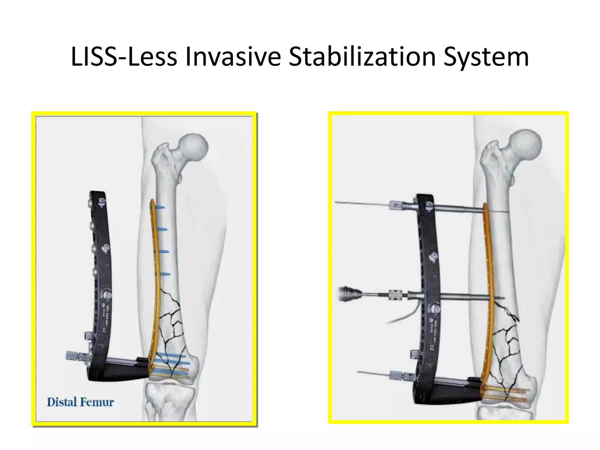 LISS-Less Invasive Stabilization System
 