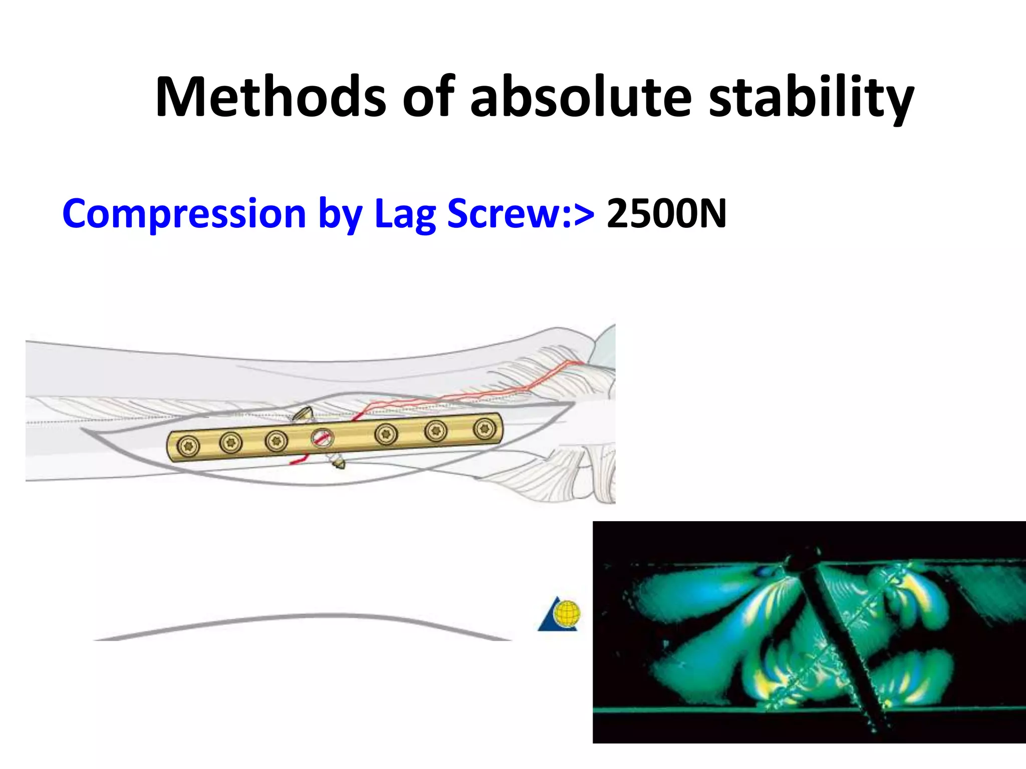 Methods of absolute stability
Compression by Lag Screw:> 2500N
 