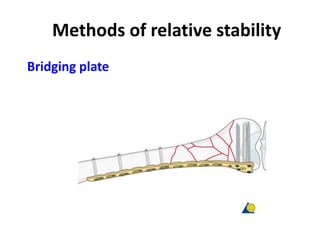 Methods of relative stability
Bridging plate
 