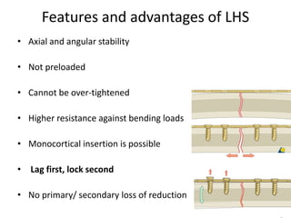 Features and advantages of LHS
• Axial and angular stability
• Not preloaded
• Cannot be over-tightened
• Higher resistance against bending loads
• Monocortical insertion is possible
• Lag first, lock second
• No primary/ secondary loss of reduction
 