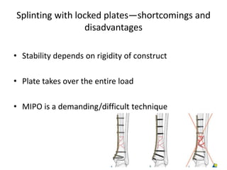 Splinting with locked plates—shortcomings and
disadvantages
• Stability depends on rigidity of construct
• Plate takes over the entire load
• MIPO is a demanding/difficult technique
 