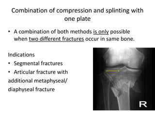 Combination of compression and splinting with
one plate
• A combination of both methods is only possible
when two different fractures occur in same bone.
Indications
• Segmental fractures
• Articular fracture with
additional metaphyseal/
diaphyseal fracture
 