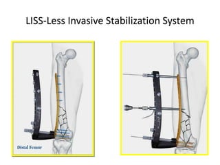 LISS-Less Invasive Stabilization System
 