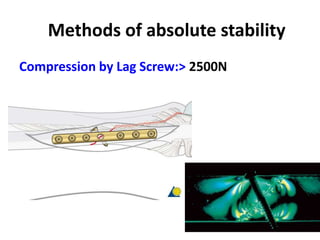 Methods of absolute stability
Compression by Lag Screw:> 2500N
 