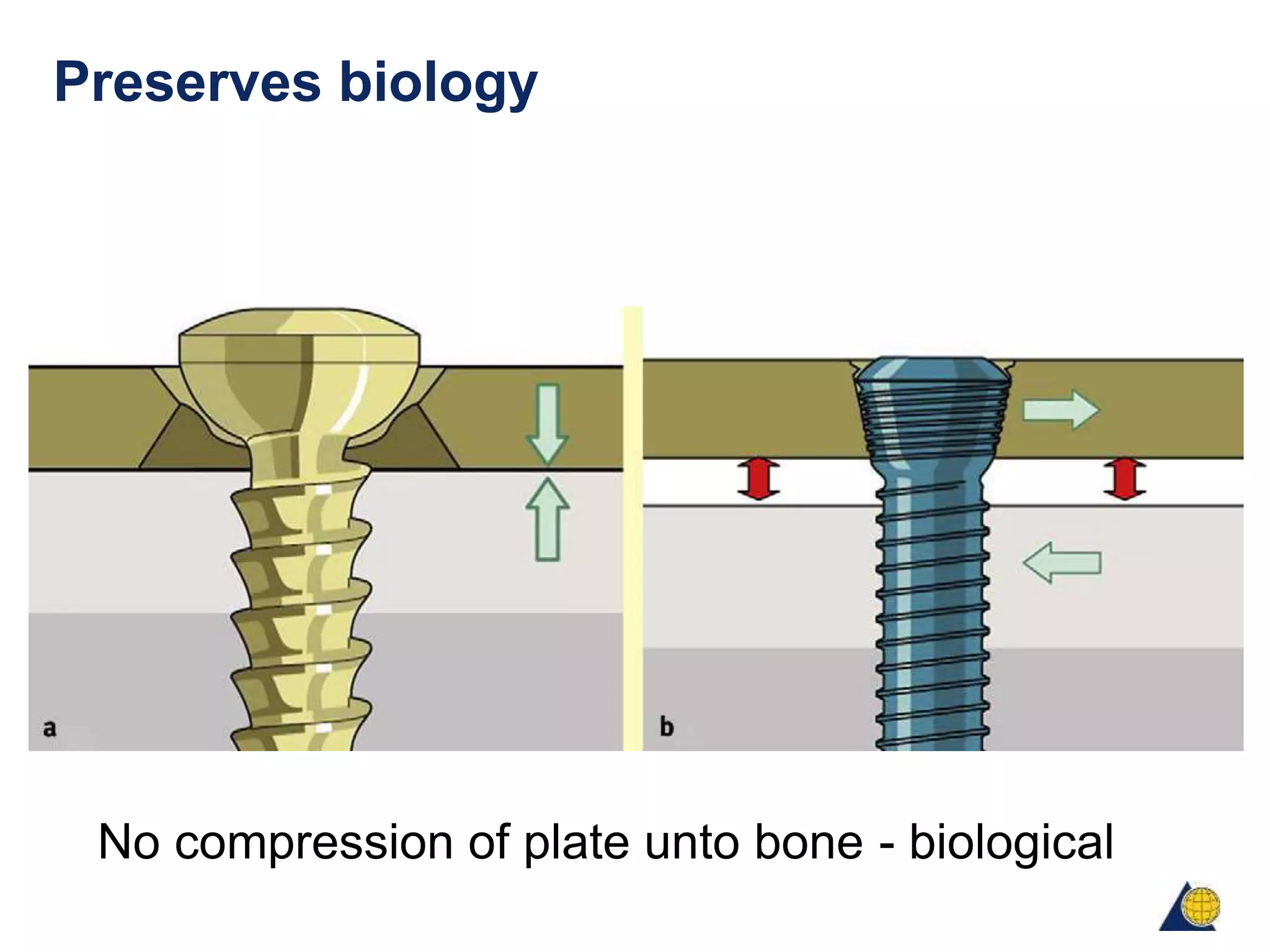 Principles of lock plate fixation AO | PPTX