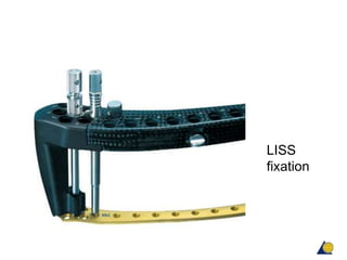 Principles of lock plate fixation AO | PPTX
