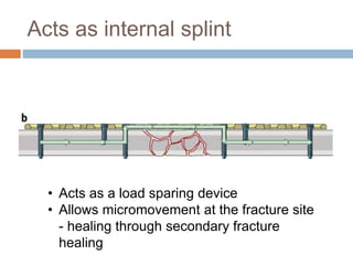 Acts as internal splint
• Acts as a load sparing device
• Allows micromovement at the fracture site
- healing through secondary fracture
healing
 
