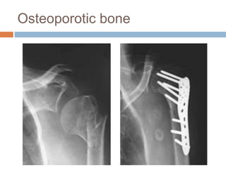Osteoporotic bone
 
