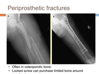 Periprosthetic fractures
• Often in osteoporotic bone
• Locked screw can purchase limited bone around
 